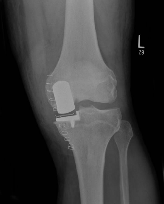 New Unicompartmental Knee Replacement