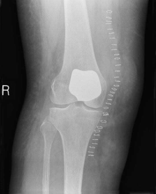 Patello-femoral Knee Replacement