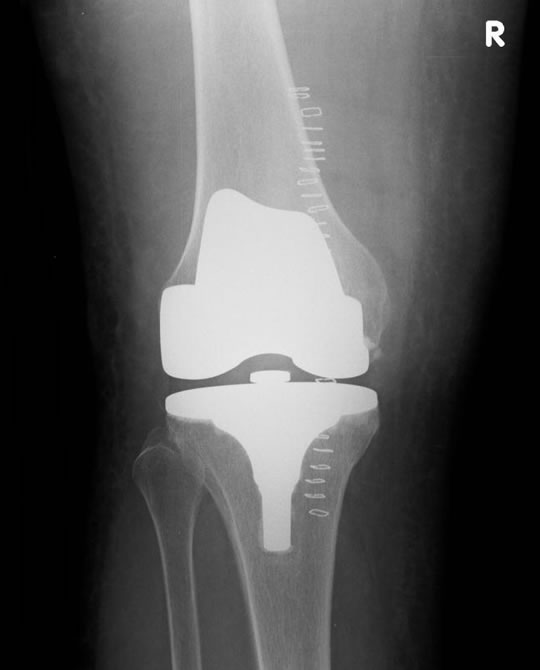 Primary Total Knee Replacement